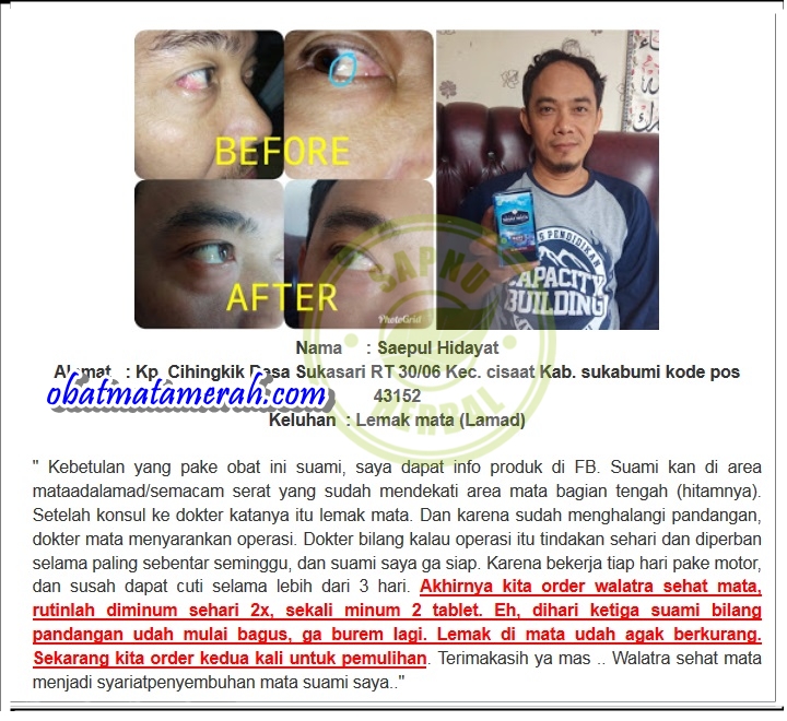 Cara Alami Mengobati Lemak Di Mata Sampai Sembuh Total